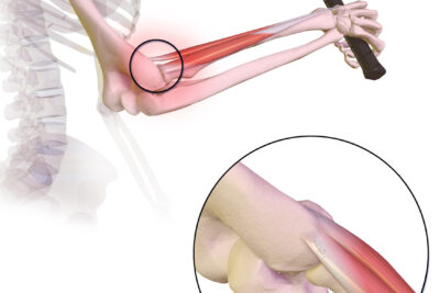 tennis elbow Síntomas del codo de tenista y cómo tratarlos